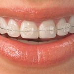 Niềng răng mang mắc cài bao lâu ?