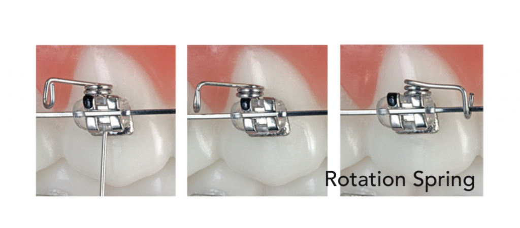 Lò xo xoay Rotation Spring Right/Left – Vật Liệu Chỉnh Nha AO ...